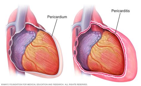 Pericarditis Symptoms And Causes Mayo Clinic