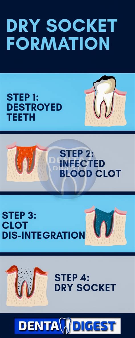 Dry Socket Everything You Need To Know Denta Digest