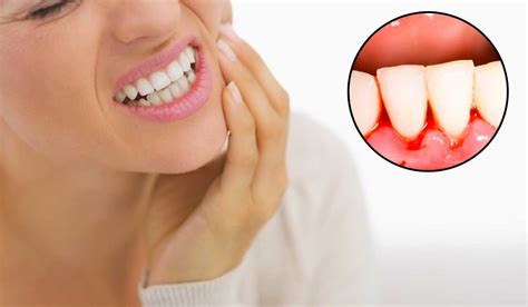 Clear margins in any cancer surgery means that in the sample of tissue that they are talking about the cancer does not extend to the edge of the sample. Bleading gums, what it means and what you need to do ...