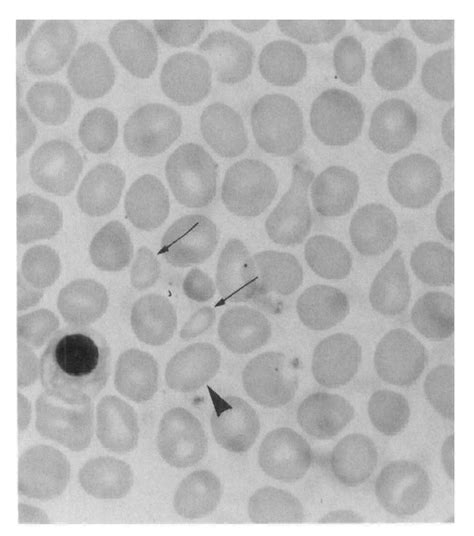 Peripheral Blood Smear From A Patient With Agnogenic Myeloid