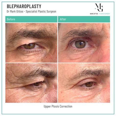 Eyelid Lift Photos In Nz Dr Mark Gittos Plastic Surgeon