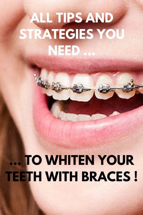 However, this can be quite expensive. Can You Get Your Teeth Whitened With Braces On - TeethWalls