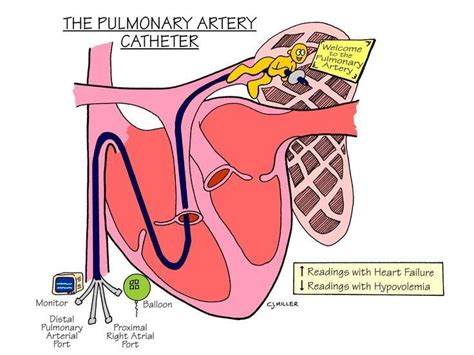 Pulmonary Artery Catheter Intervention Studypk