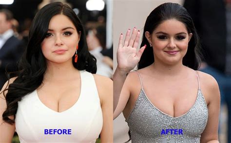 Areola Reduction Before And After Pictures