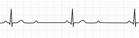 Atrioventricular Av Block Bradyarrhythmias Medschool