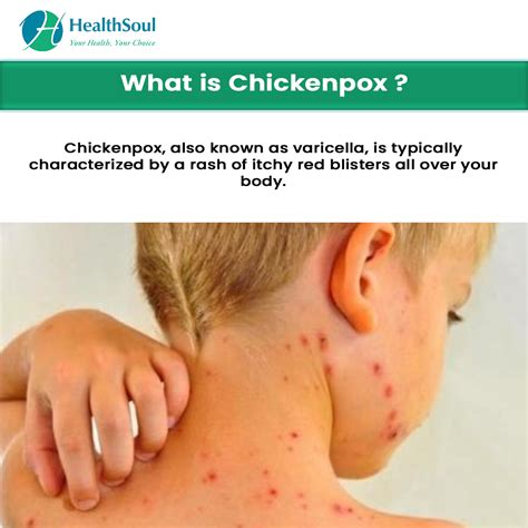 Chickenpox Symptoms And Treatment Healthsoul