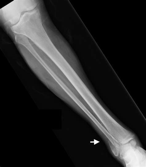 Shortening Of Leg Due To Fracture