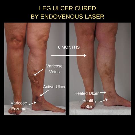 Leg Ulcers The Veincare Centre