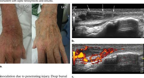 Pdf Soft Tissue Infections And Their Imaging Mimics From Cellulitis