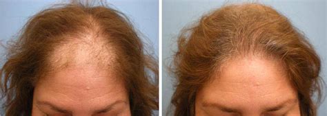 Five Step Female Hair Loss Treatment