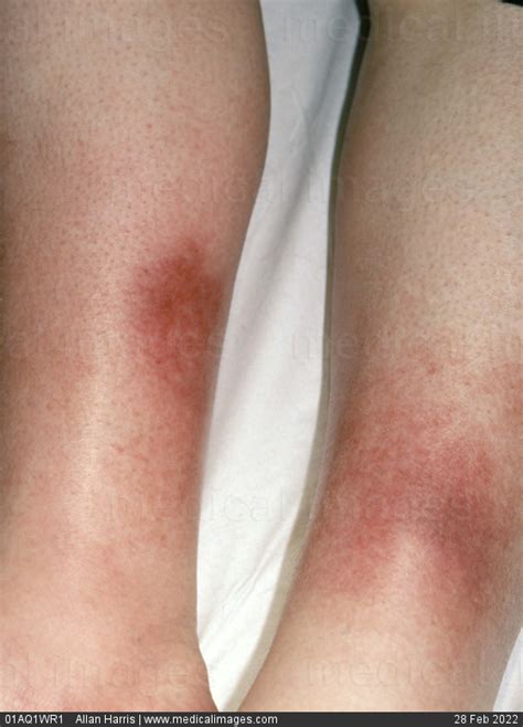 Stock Image Dermatology Insect Bites Inflamed Red Patches With