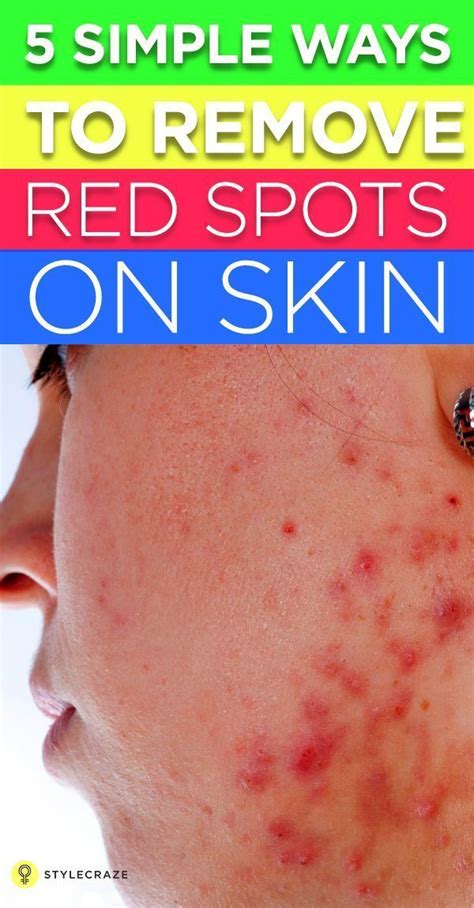 6 Natural Ways To Treat Red Spots On Skin And Prevention Tips Skin