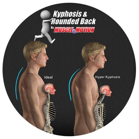Kyphosis And Rounded Back Muscleandmotion Strength Training Anatomy