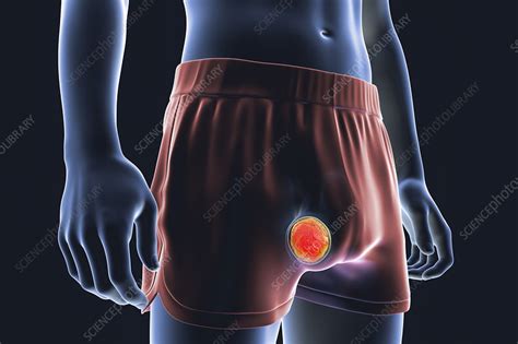 Testicular Cancer Illustration Stock Image F Science Photo Library