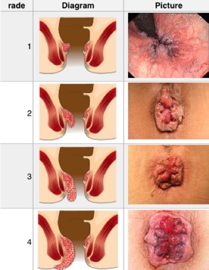Mcconnell treats hemorrhoids, performs anoscopies and colonoscopies, and can identify the precursors to cancer as well as the cancer itself. Fort Langley Colonics Hemorrhoids