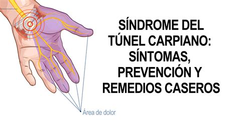 Síndrome Del Túnel Carpiano Síntomas Prevención Y Remedios Caseros