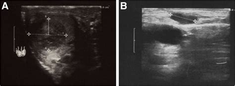 Testicular And Inguinal Lymph Node Metastases Of Medullary Thyroid