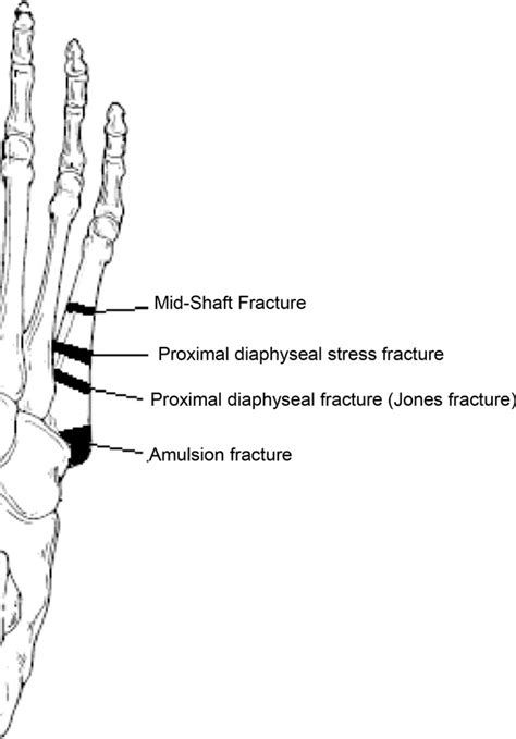 Proximal Fifth Metatarsal Fracture