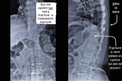 Compression Fracture Of The Thoracic Spine Causes Symptoms And