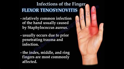 Infections Of The Finger Everything You Need To Know Dr Nabil