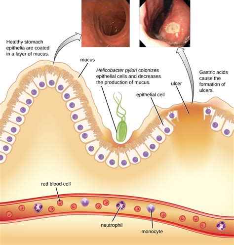 Gastroenteritis Is An Inflammation Of The Lining Of The Intestines