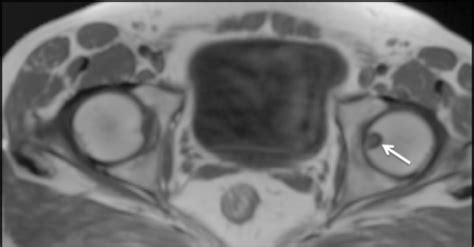 T1 Weighted Axial Mri Showing A Corresponding Hypointen Open I