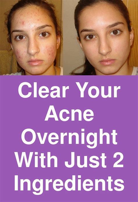 10 Ways To Get Rid Of A Pimple Overnight Acne Overnight Bad Acne