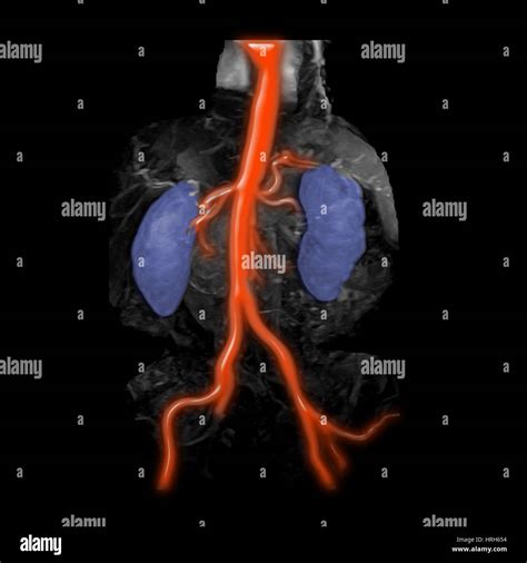 Abdominal Aorta Kidneys And Iliac Arteries Stock Photo Alamy