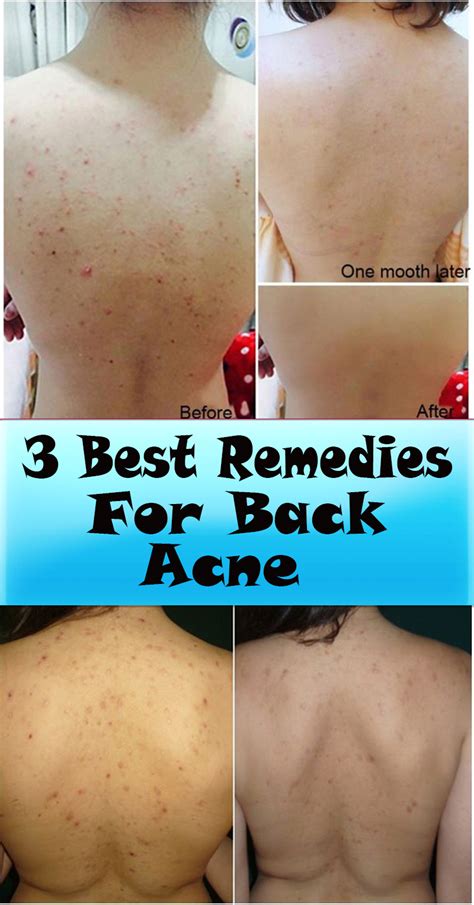 Back Acne It Is An Absolutely Embarrassing And Uncomfortable Skin