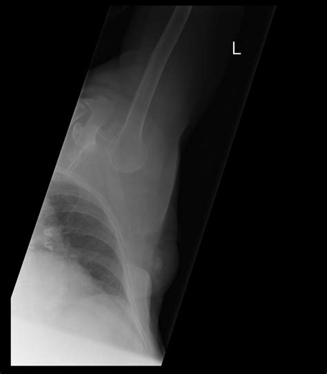 Posterior Shoulder Dislocation Radiology At St Vincent S University