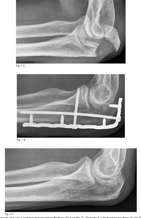 Figure 1 From Clinical Evaluation Of Locking Compression Plate Fixation