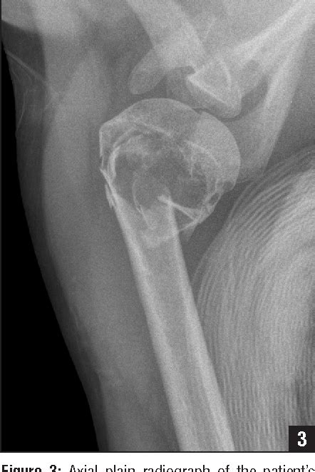 Figure 2 From Three Part Head Splitting Proximal Humerus Fracture