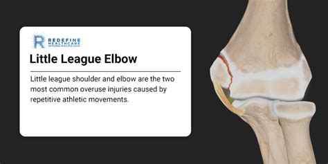Little League Shoulder And Elbow Njs Top Orthopedic Spine And Pain