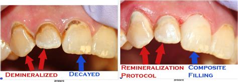 Remineralization Is Real Reversing Bracket Scars And Discolored Roots
