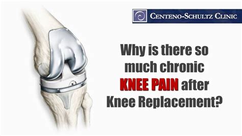 Knee Replacement The Pain Afterwards Things To Know