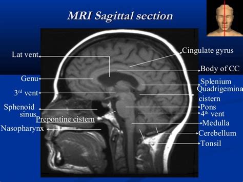 40 Midline Sagittal Brain Anatomy Mri