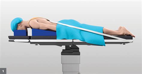 Minimally Invasive Posterior Cervical Fusion Augments Three Level