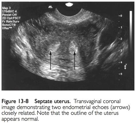 Uterine Ultrasound Imaging