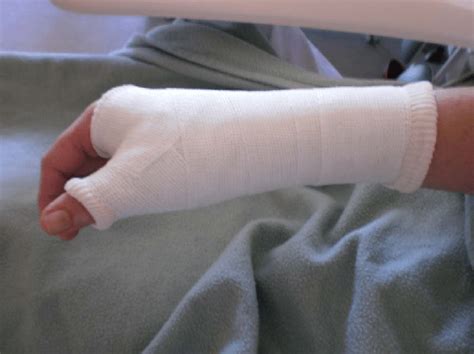 Immobilization Of Wrist And Thumb By Circular Cast Download