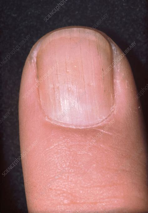 Psoriatic Arthritis Fingernail Stock Image C0365640 Science