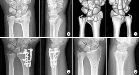 Case Of A 31 Year Old Male With An Intraarticular Distal