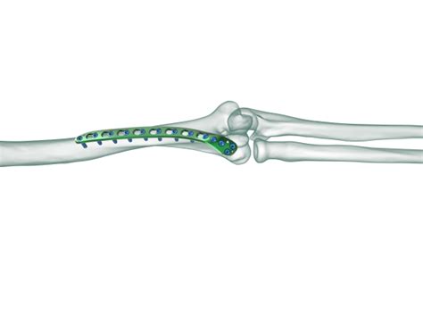 True Lock Distal Humerus Posterolateral Anatomic Plate Truemed Medikal