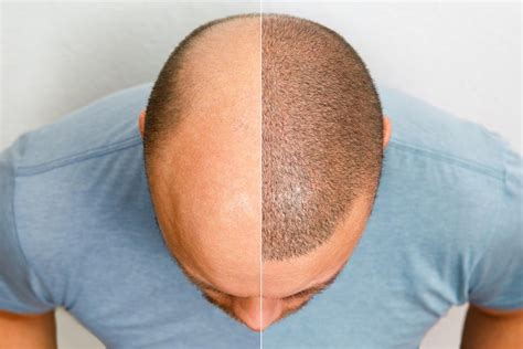 Hair Transplant Surgery Myths Vs Facts Debunking Common Misconceptions