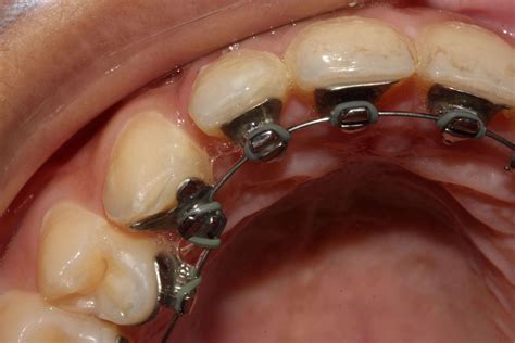 Mission Viejo Lingual Braces South Oc Orthodontics