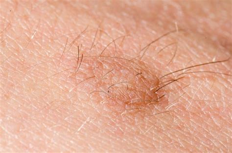 10 Possible Causes For Those Bumps On Your Skin Facty Health