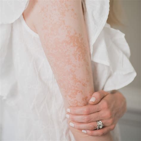 10 Things To Know About Vitiligo Vanquish Living Dappled