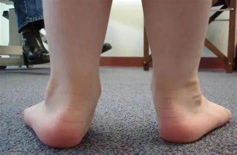 Flat Feet In Children Diagnosis And Treatments Orthopaedic Surgeon