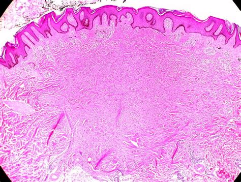 Dermatofibroma — Pathology Outlines And Treatment Medical Library