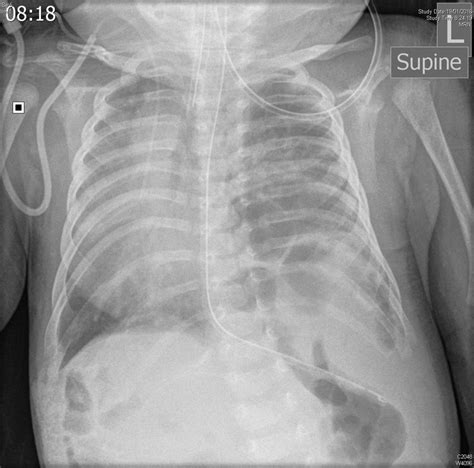 Rare Combination Of Left Sided Congenital Diaphragmatic Hernia And