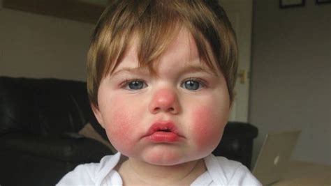 Things To Know About The Slapped Cheek Syndrome Starmommy